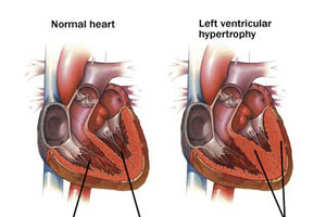 Masked hypertension